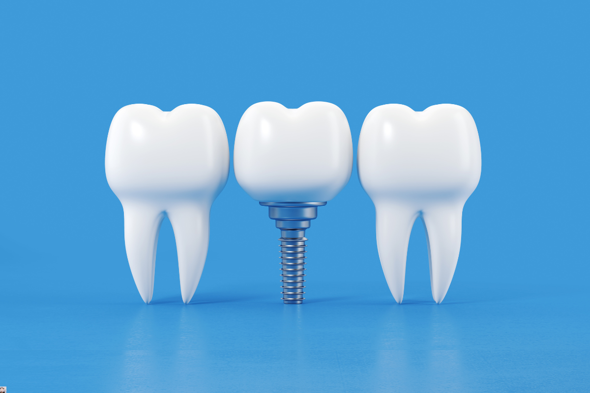 Dental Implants